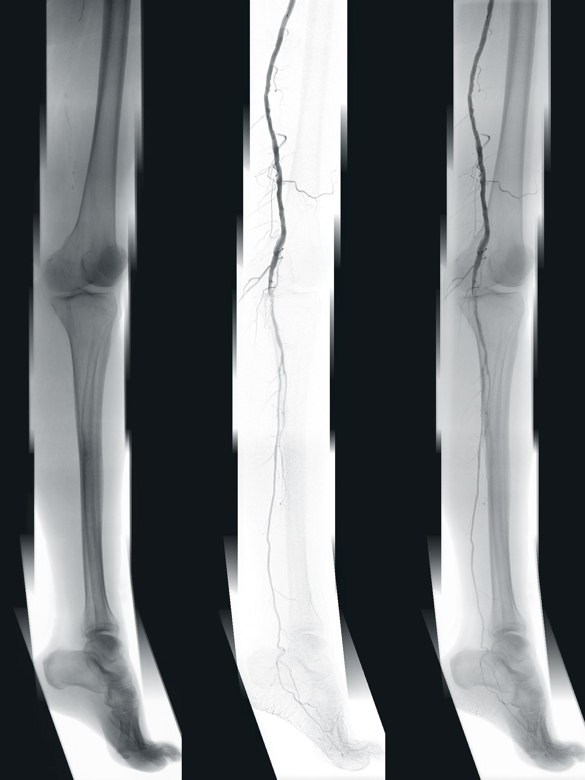 Clinical image: Pre-operative 2D fluoroscopic, angiographic, and combined fluoroscopic and angiographic panoramas