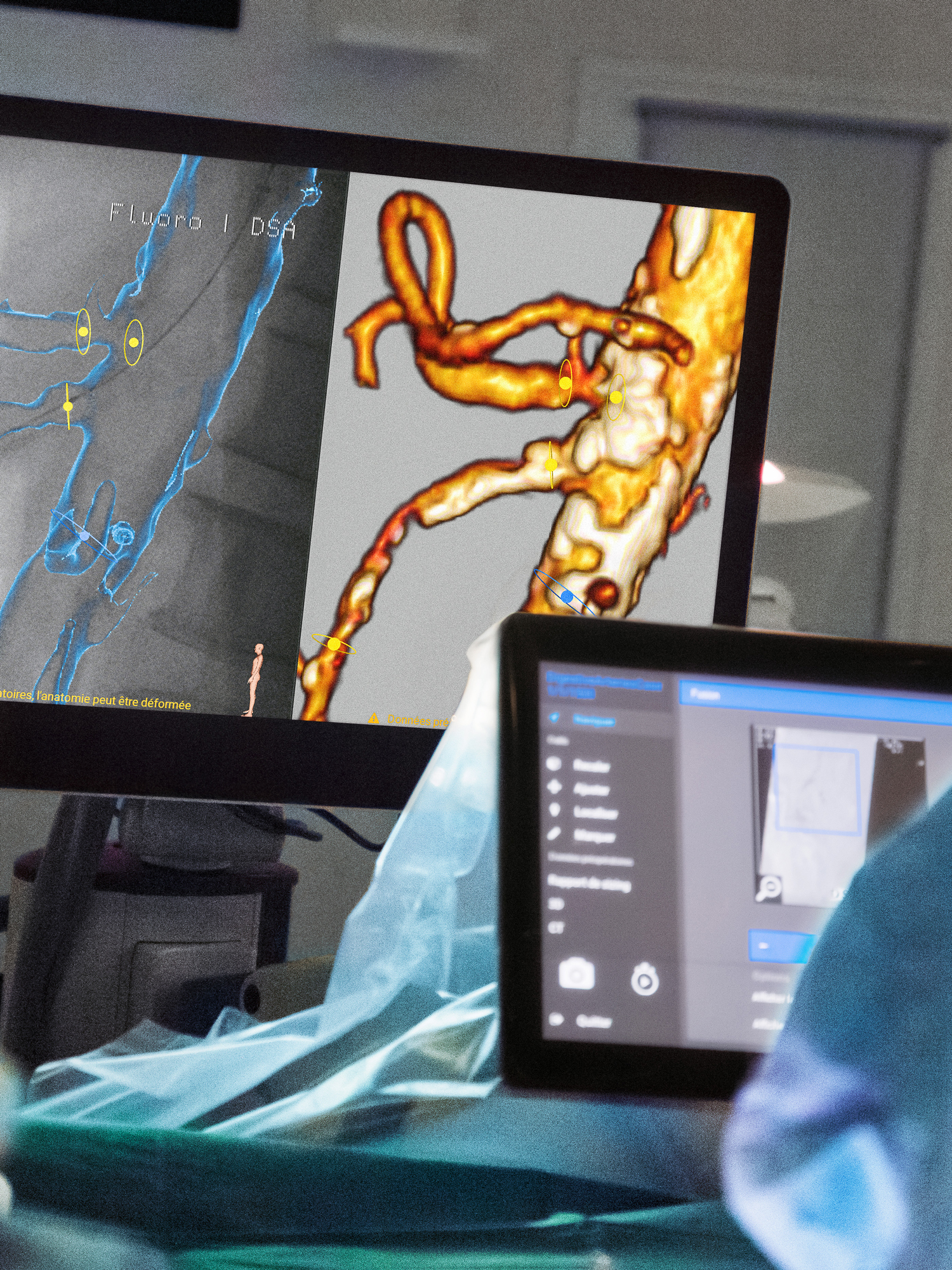 Two monitors in an operating room: one shows the overlay of pre-processed CT images with live C-arm images; the other shows a user interface for setting scan parameters.