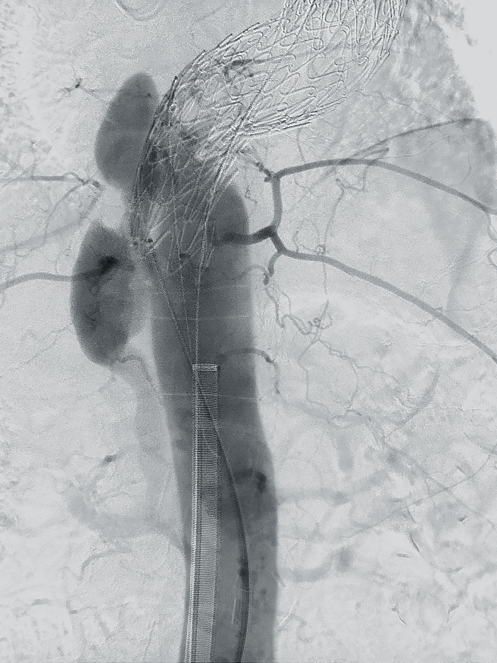 Clinical image abdominal aortic aneuryms