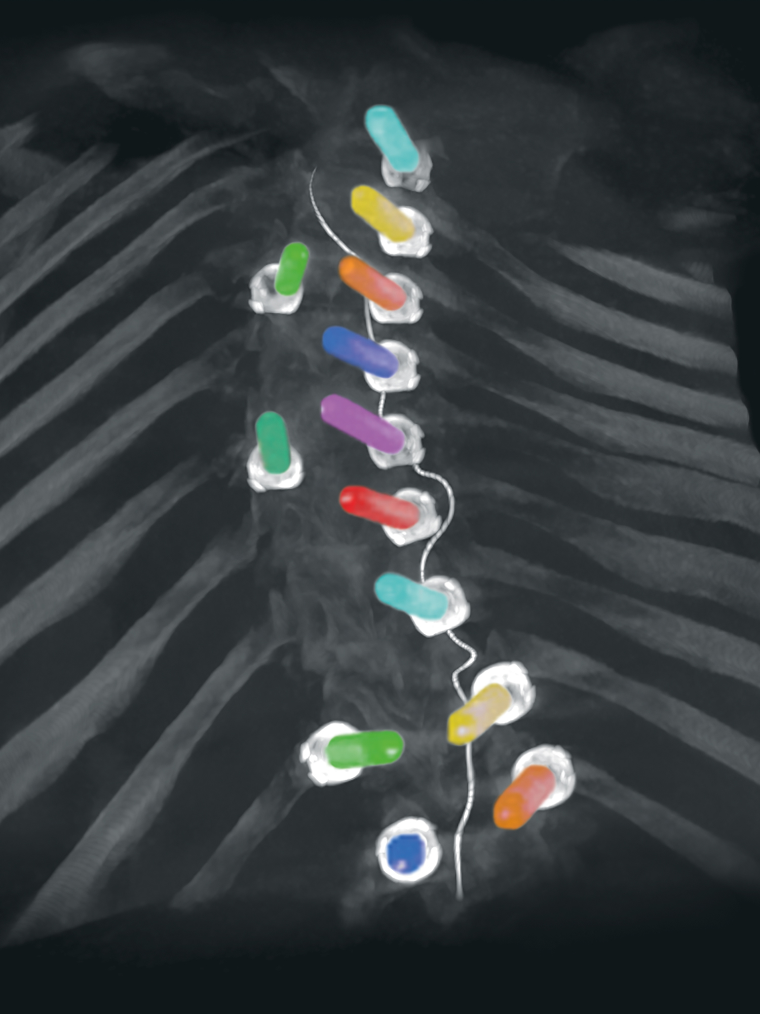 Clinical image of a Thoracic Spondylodesis (T3-T11) for the treatment of idiopathic scoliosis