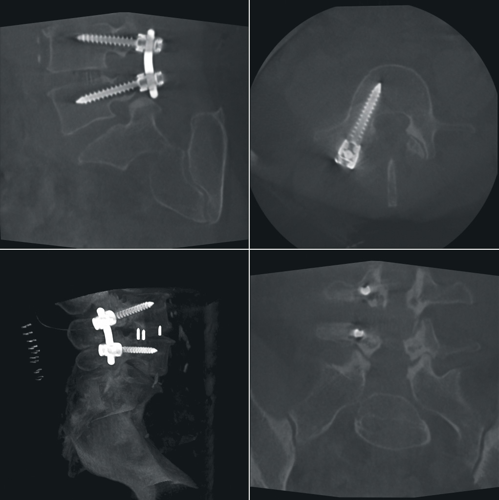 Chirurgie de la colonne vertébrale