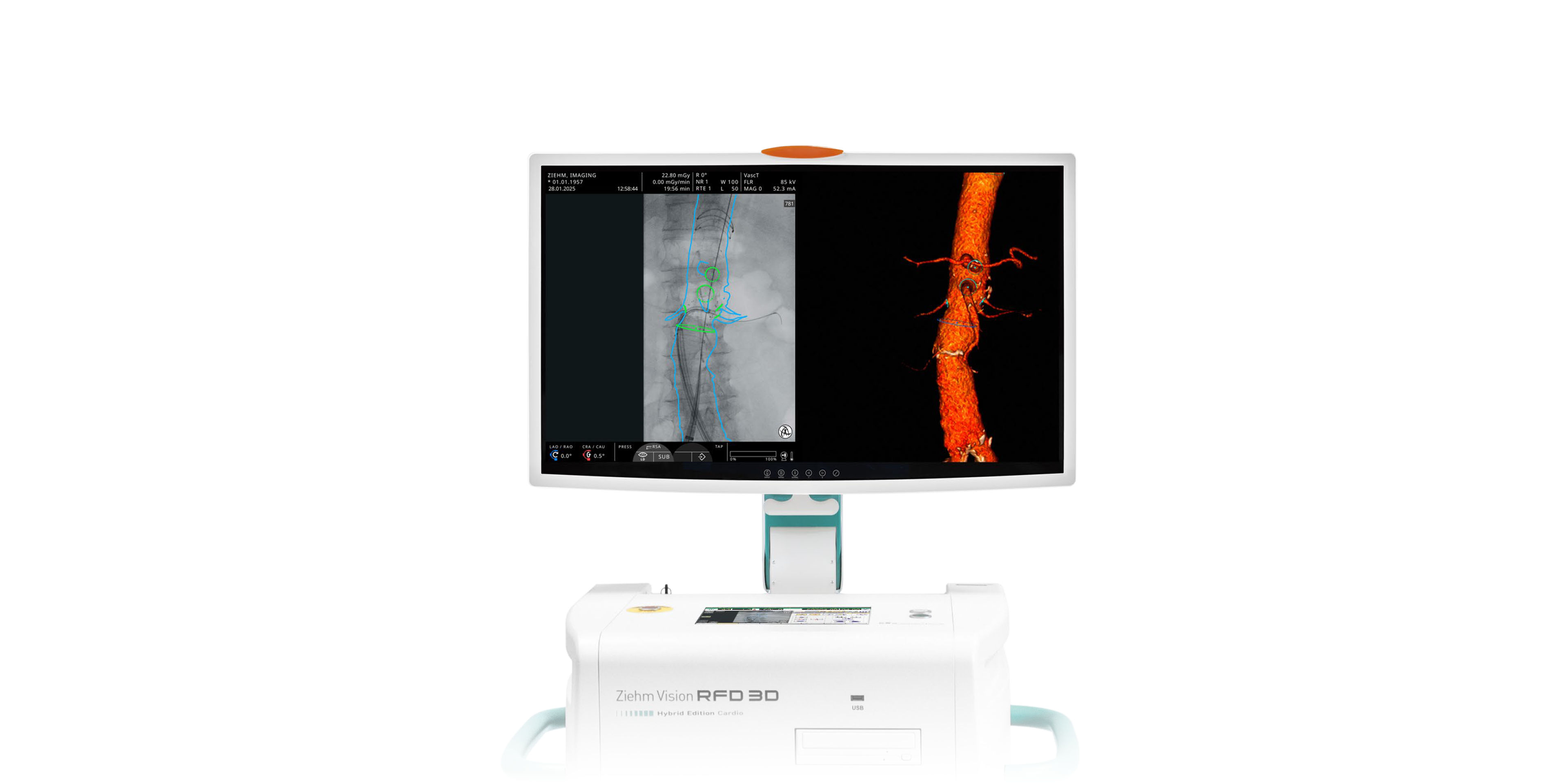 Endovascular Navigation