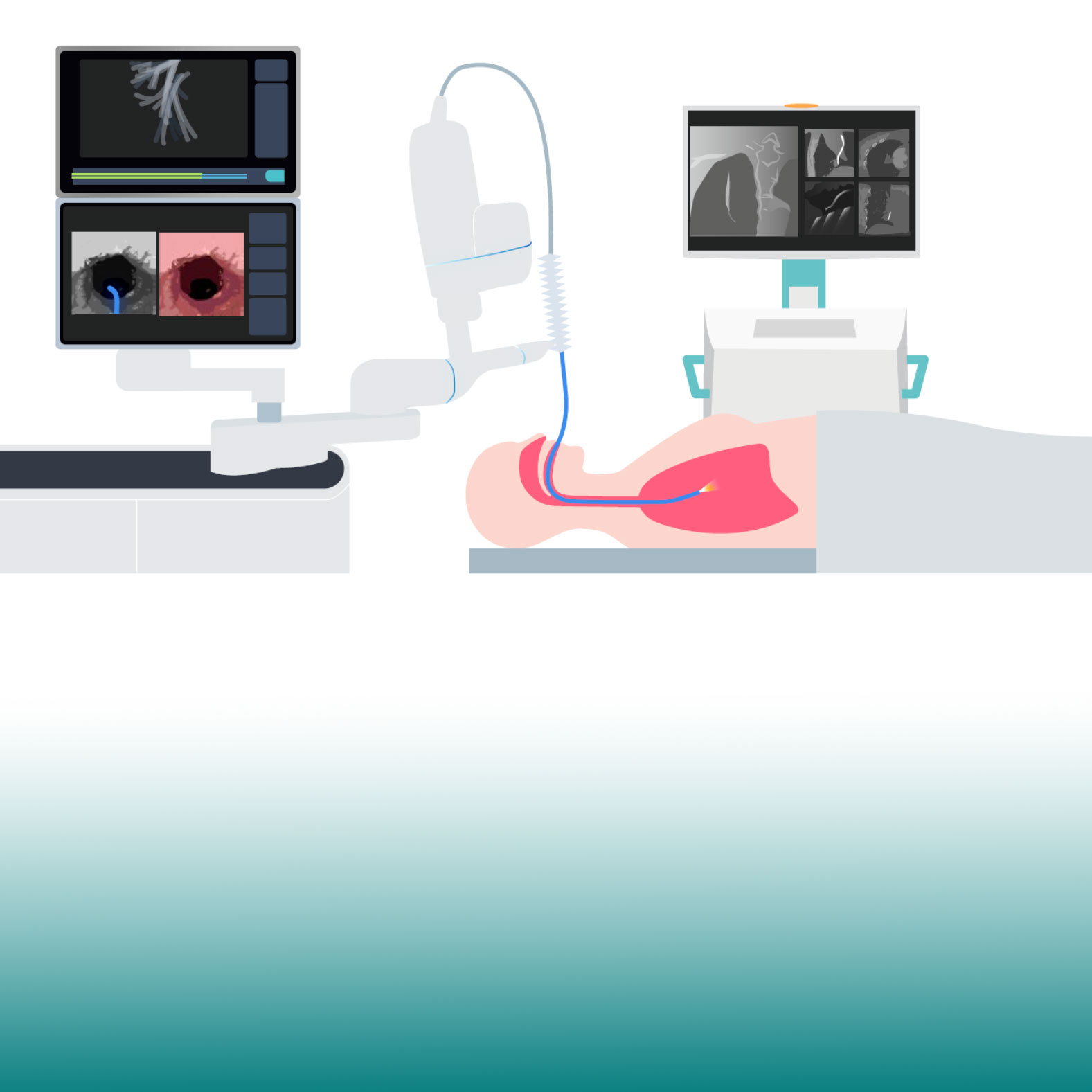 Precision in lung nodule biopsy - Whitepaper