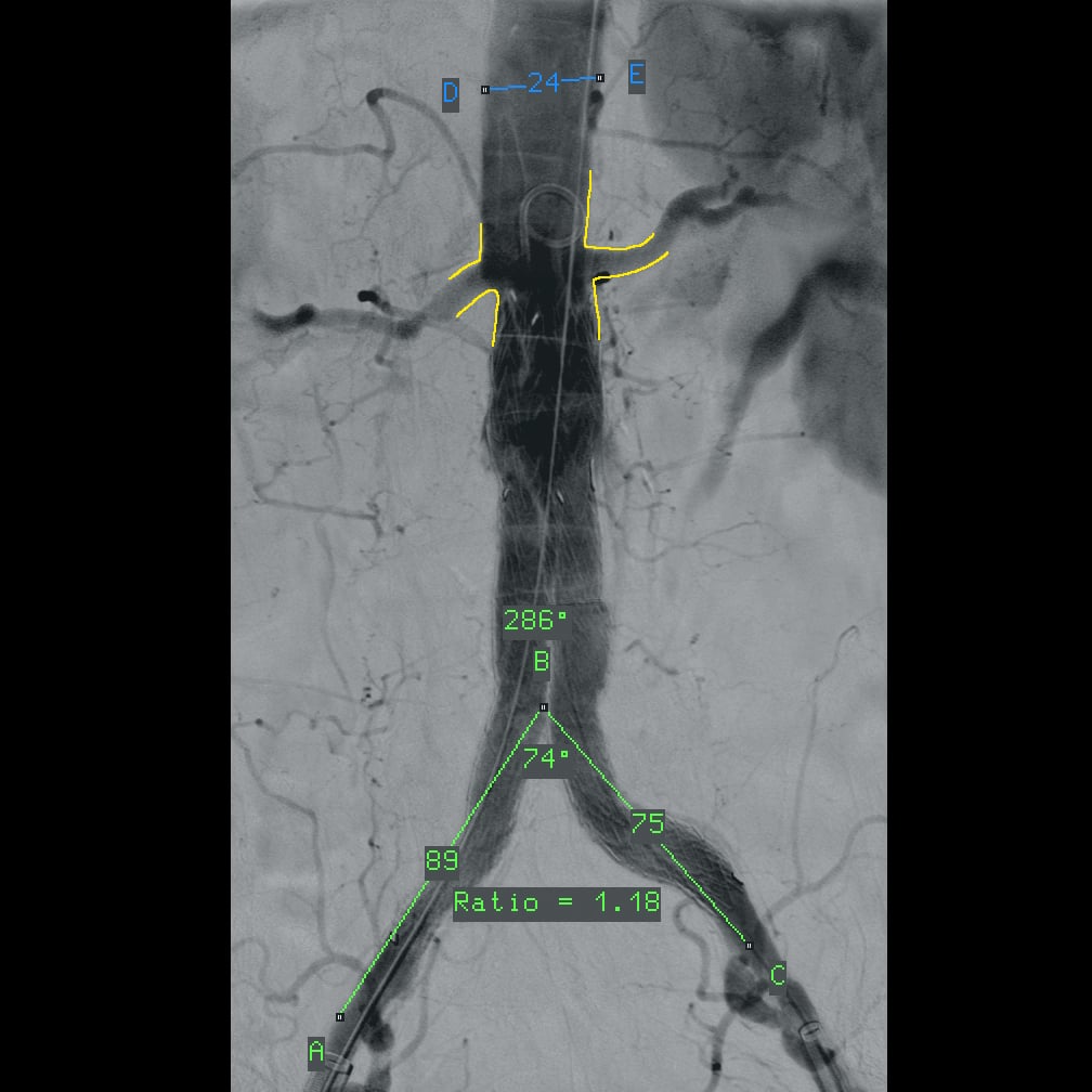 Vascular surgery