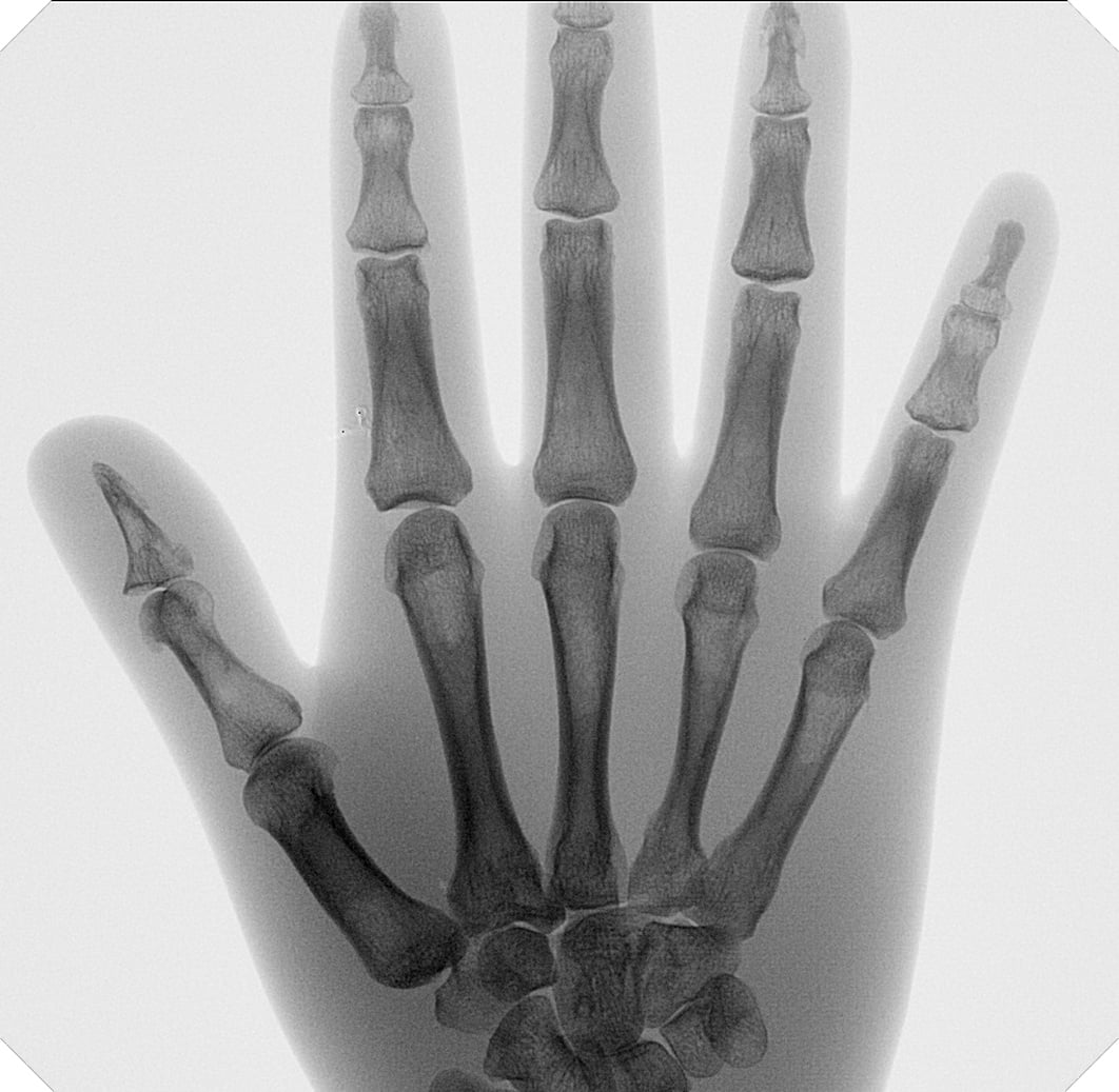 Hand and Foot Surgery - Ziehm Imaging | EN